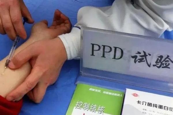 ppd可排除结核感染风险