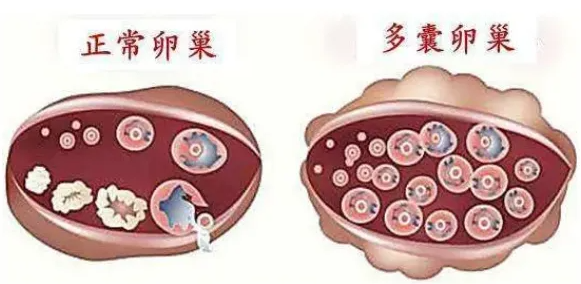 多囊卵巢综合症怎么治疗能怀孕.png