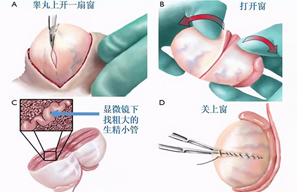 穿刺取精只能做试管婴儿