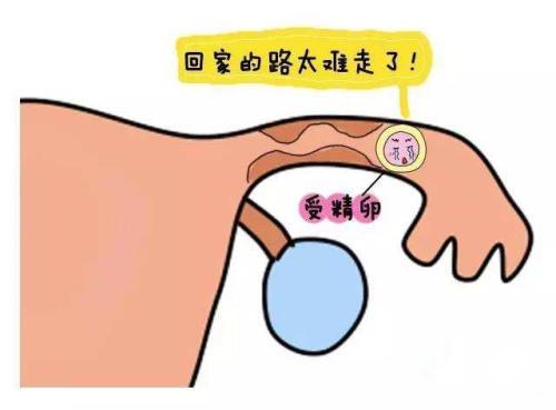 宫外孕0.jpg