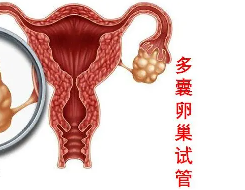 多囊适合哪种方案试管.png