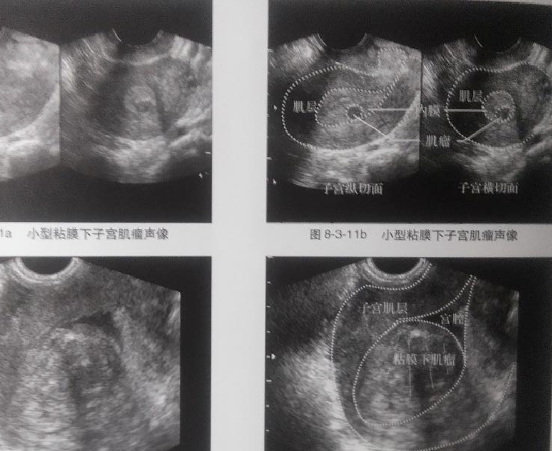 子宫肌瘤大小会影响移植