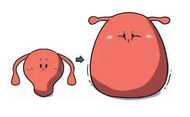 子宫腺肌症子宫增大.png