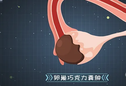 做过巧囊手术是不是很难怀孕.png