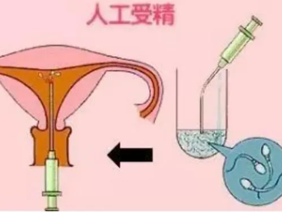 人工受精成功率和精子关系大