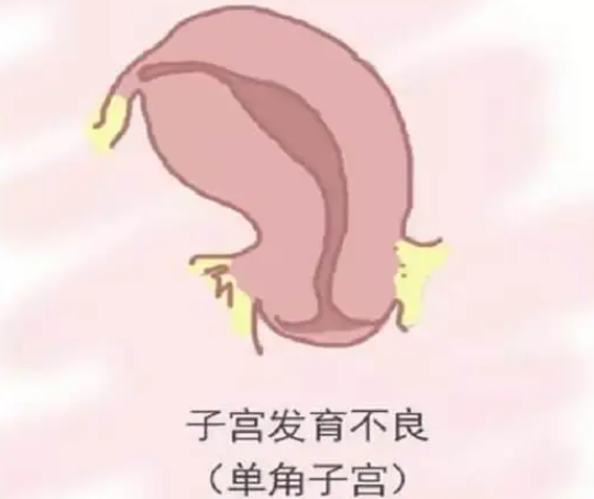 单角子宫<a href=