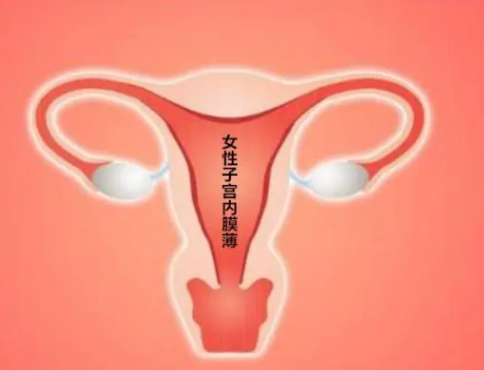 子宫内膜薄会导致移植失败