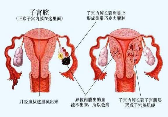 内膜异位症直接试管的理由